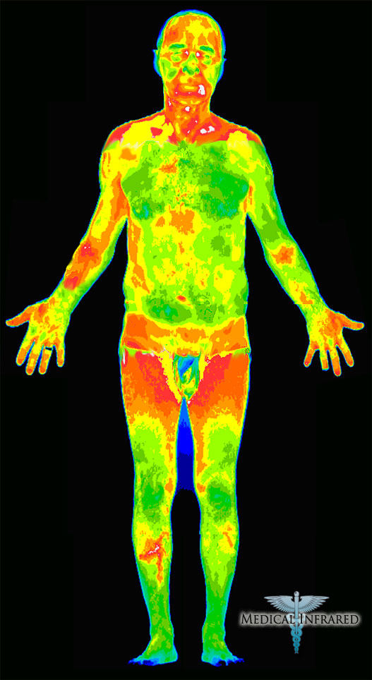 human body thermography